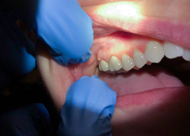 Best Emergency Dentist for Lost Fillings or Crowns in Hewitt, TX